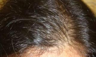 婴儿头发稀少怎么办 婴儿头发稀少怎么办